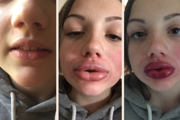 kylie jenner lip challenge gone wrong 2015