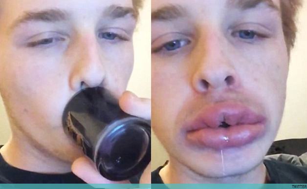kylie jenner lips challenge not healthy 2015